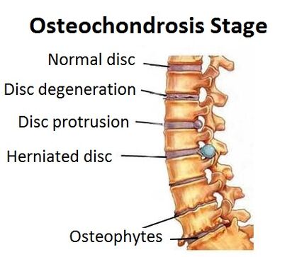 The stages of osteoarthritis