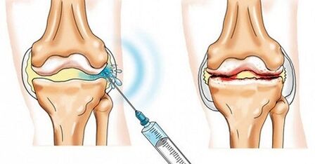 How to treat knee joint disease