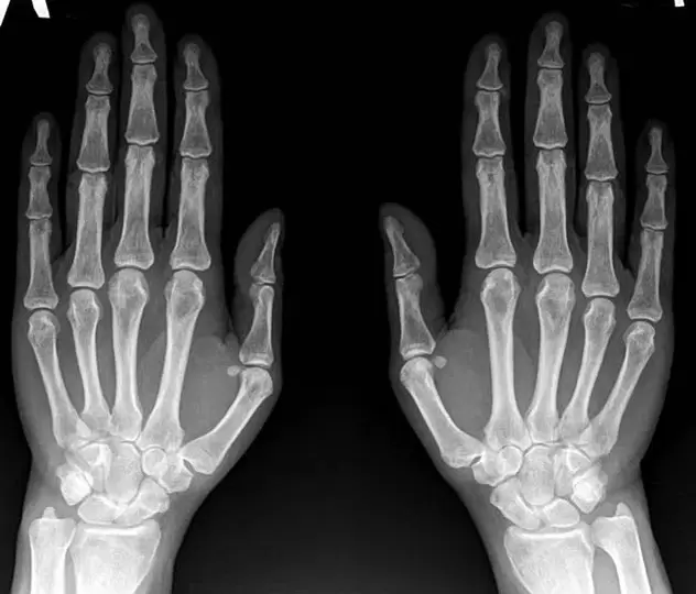 wrist arthritis on x-ray before using Hondroine